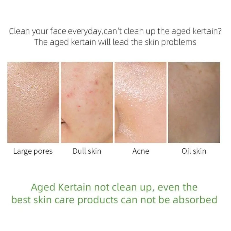 Face Care Beauty Acid Peeling Gel Exfoliating Scale Deep Carnation Remover Face Cleanser EGF Repairing Rejuvenation Beauty Salon